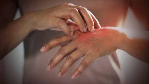 ¿Por qué es que ahora todos tienen alergias?